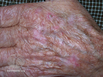 Hands Telangiectasia