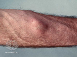 Lipoma